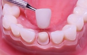 Как подготовиться к протезированию зубной коронкой?