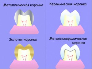 Зубные коронки и зачем они нужны?