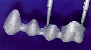 Этапы изготовления протеза из металлокерамики