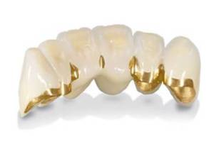 Металлокерамические коронки и зубные протезы. Протезирование зубов.