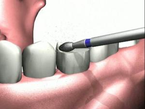 Виды уступов при препарировании зубов