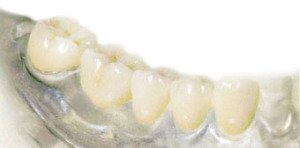 Сколько стоит керамический зуб?