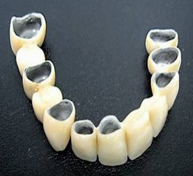 Почему протезирование зубов с помощью металлокерамики популярно?