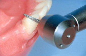 Симптомы некачественной подготовки зуба перед протезированием