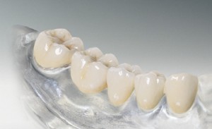 Некачественная подготовка зуба перед протезированием и боль под коронкой